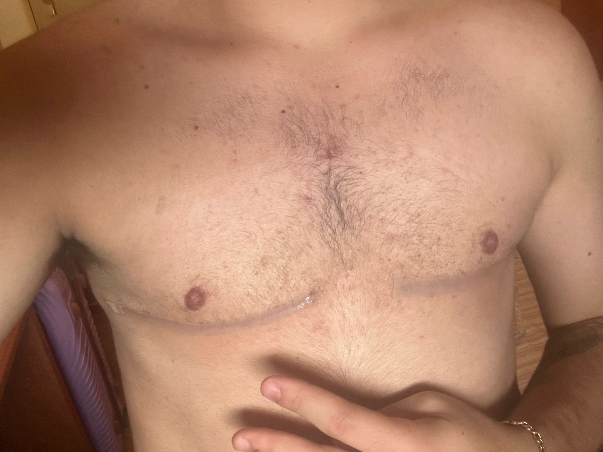 Double incision top surgery result photo