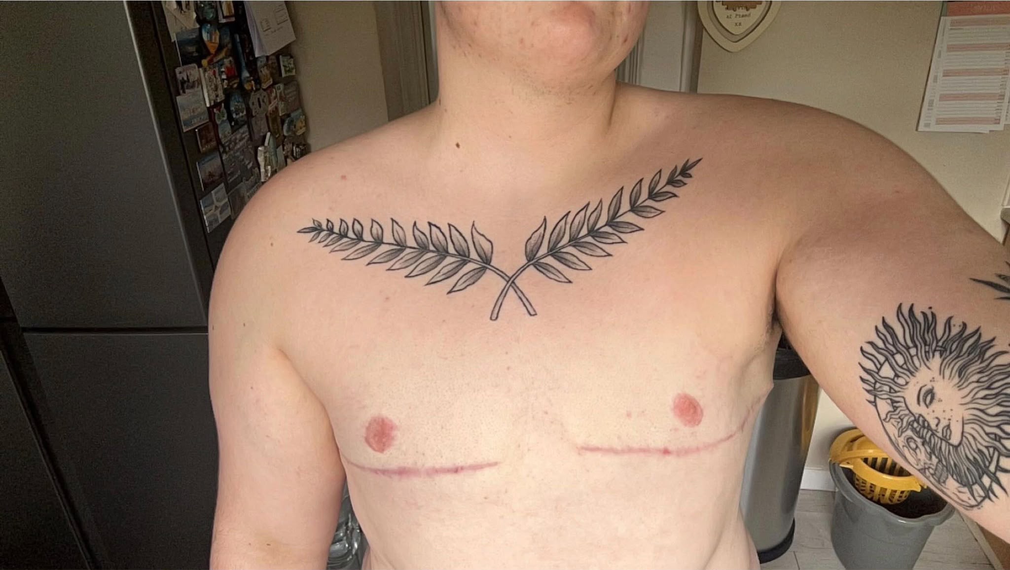 Double incision top surgery result photo