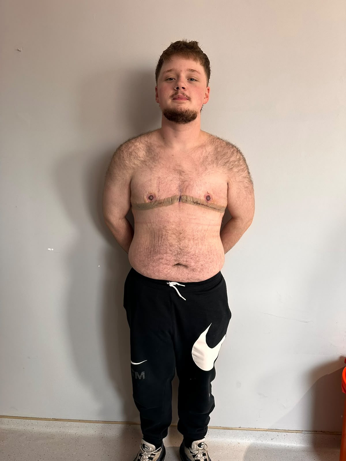 Double incision top surgery result photo