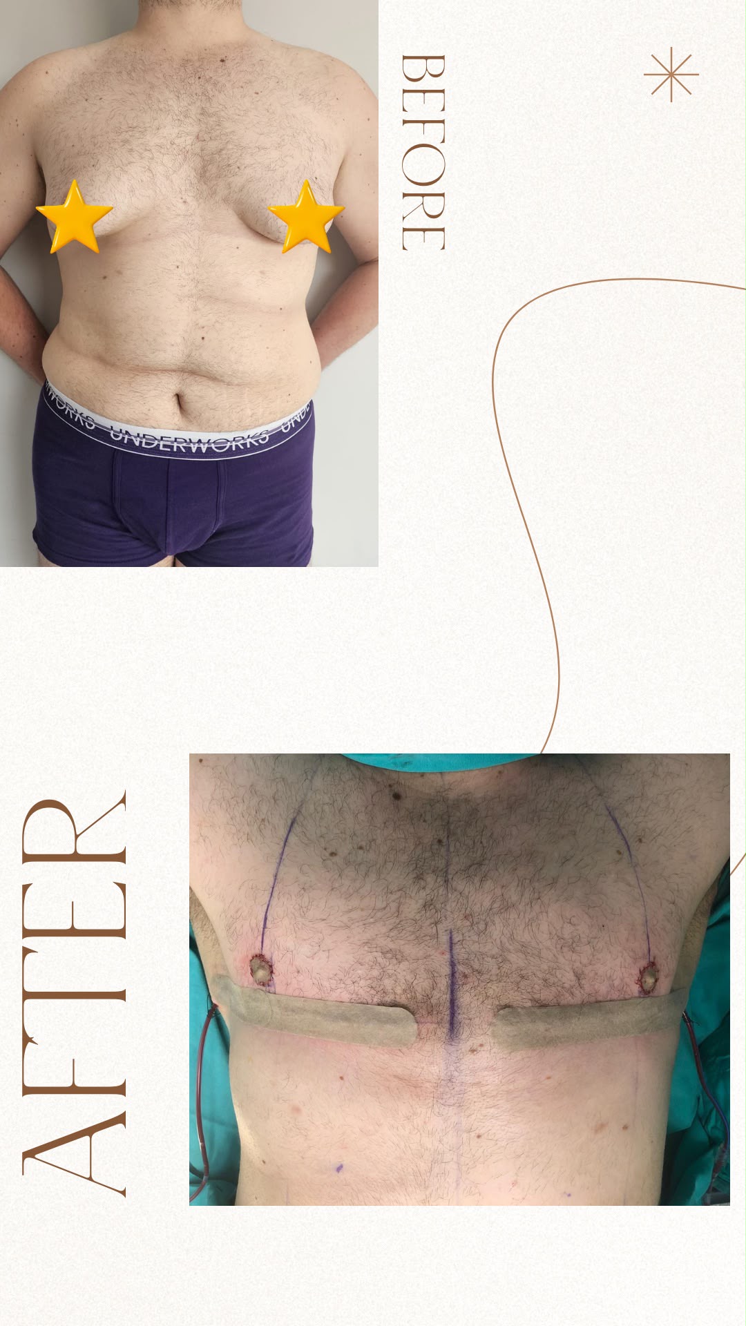 Double incision top surgery result photo