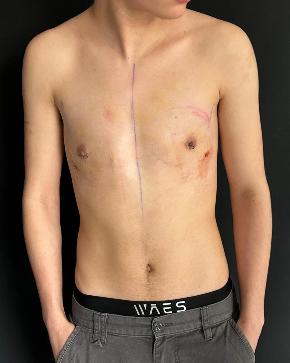 Peri-areolar top surgery — example result